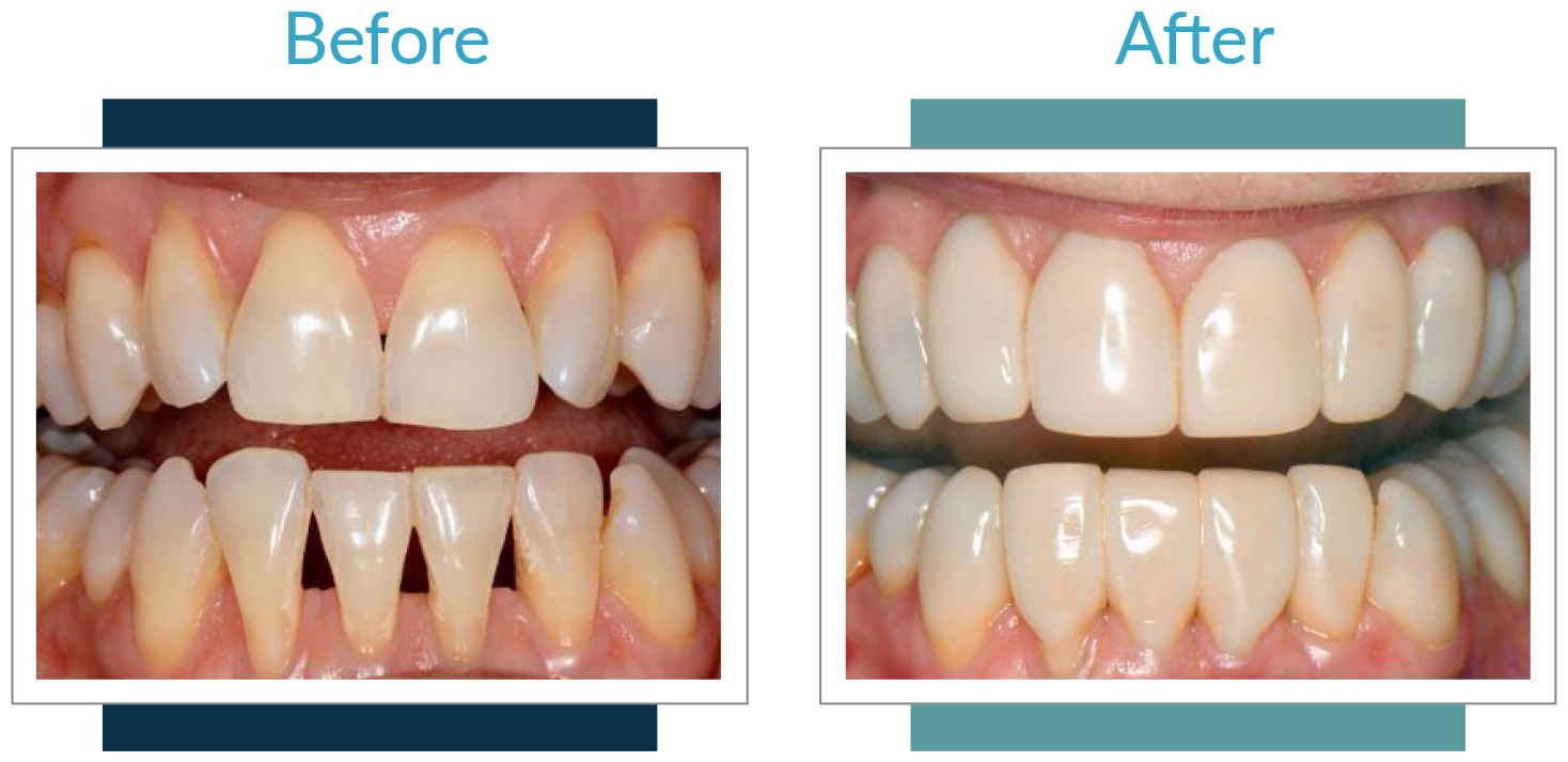 Making a patient smile with diastema closure. A minimally invasive approach  